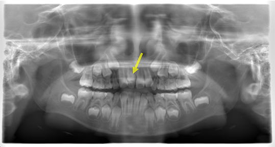 過剰歯 とは 原因 割合 手術など子供の親が知りたい情報を解説 なごみ小児歯科クリニック