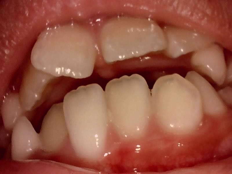 過剰歯 とは 原因 割合 手術など子供の親が知りたい情報を解説 なごみ小児歯科クリニック